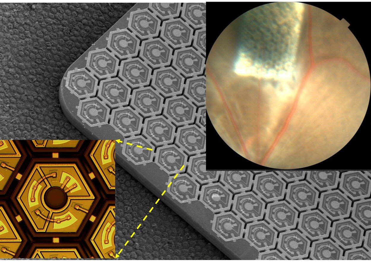 The photovoltaic chip is implanted under the retina in a blind rat (upper right corner) – it is comprised of an array of photodiodes (center and lower left) (Image: Palanker Laboratory/Stanford University)