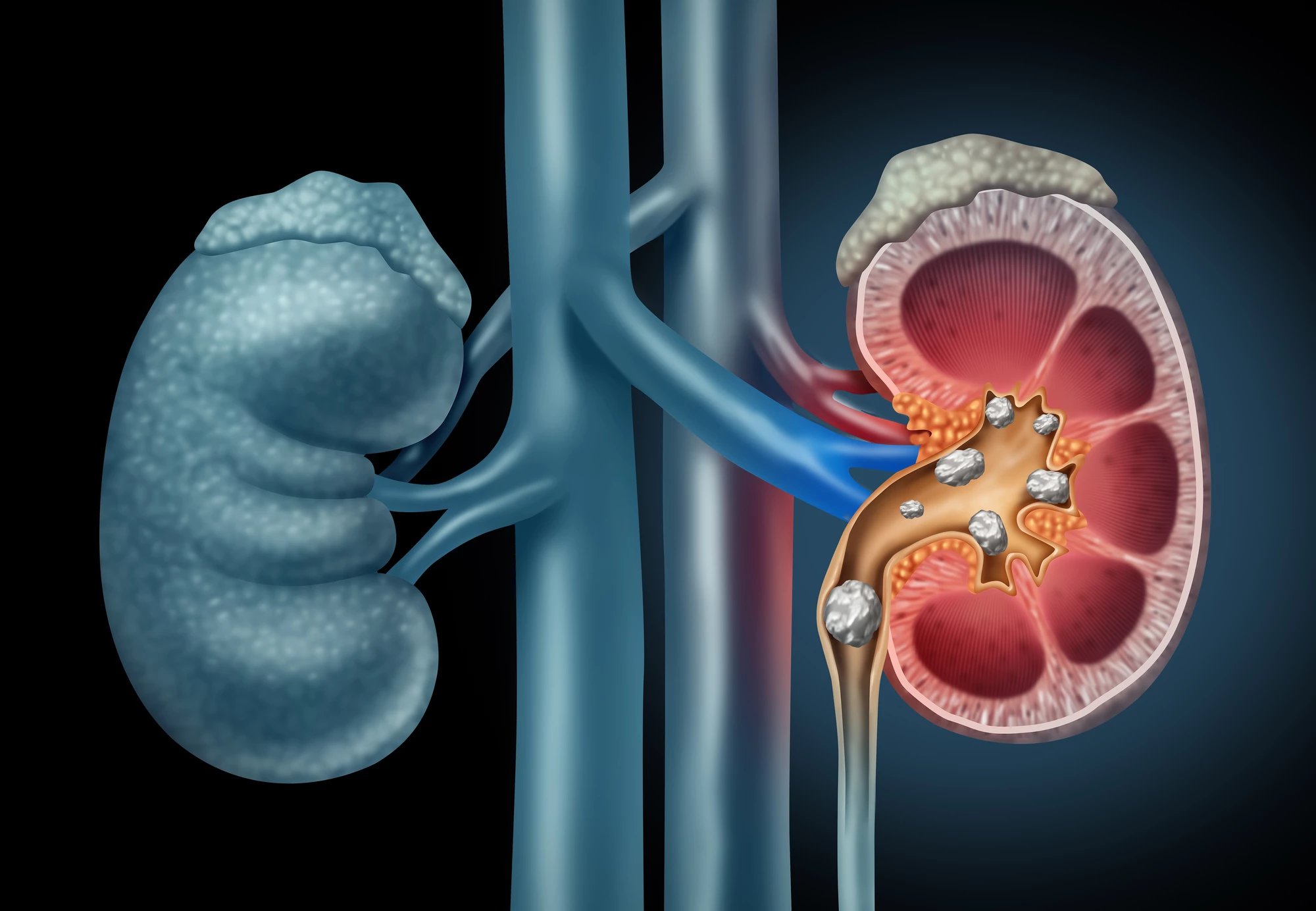 MIT researchers have found a new combination of muscle relaxing drugs that could help patients pass kidney stones less painfully