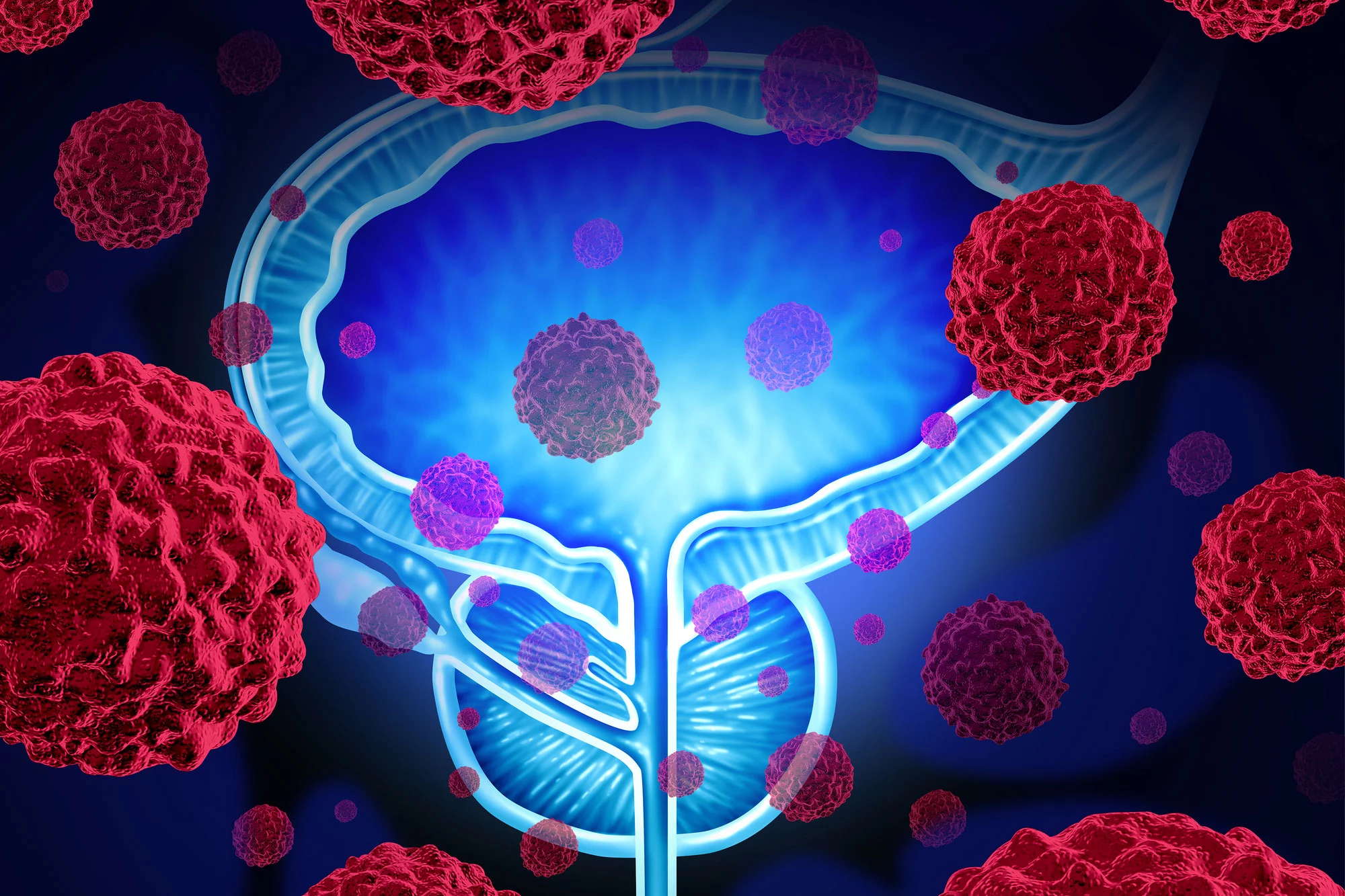 Two new techniques are designed to detect aggressive forms of prostate cancer and catch it when it metastasizes