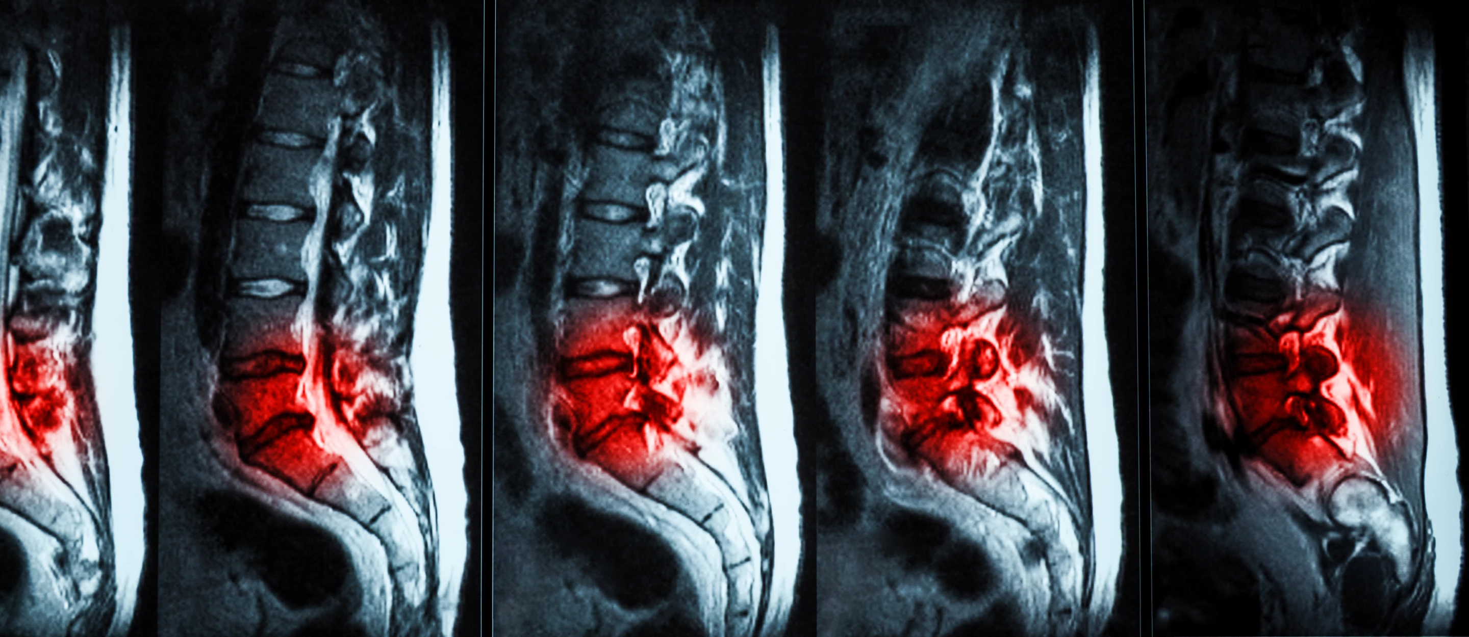 An injectable hydrogel has shown promise in repairing damaged spinal discs in a new human trial