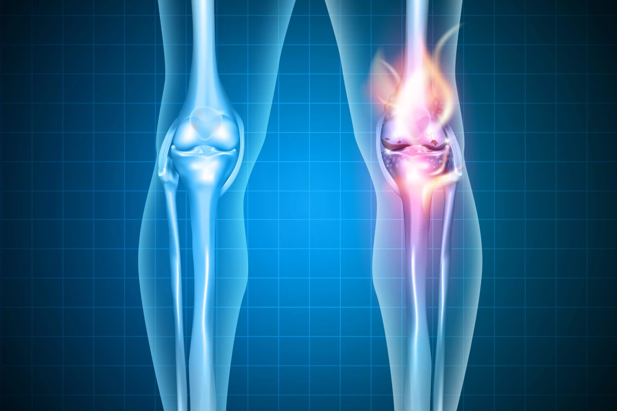 Scientists have developed a novel gel they say can prevent the onset of what's known as post-traumatic osteoarthritis