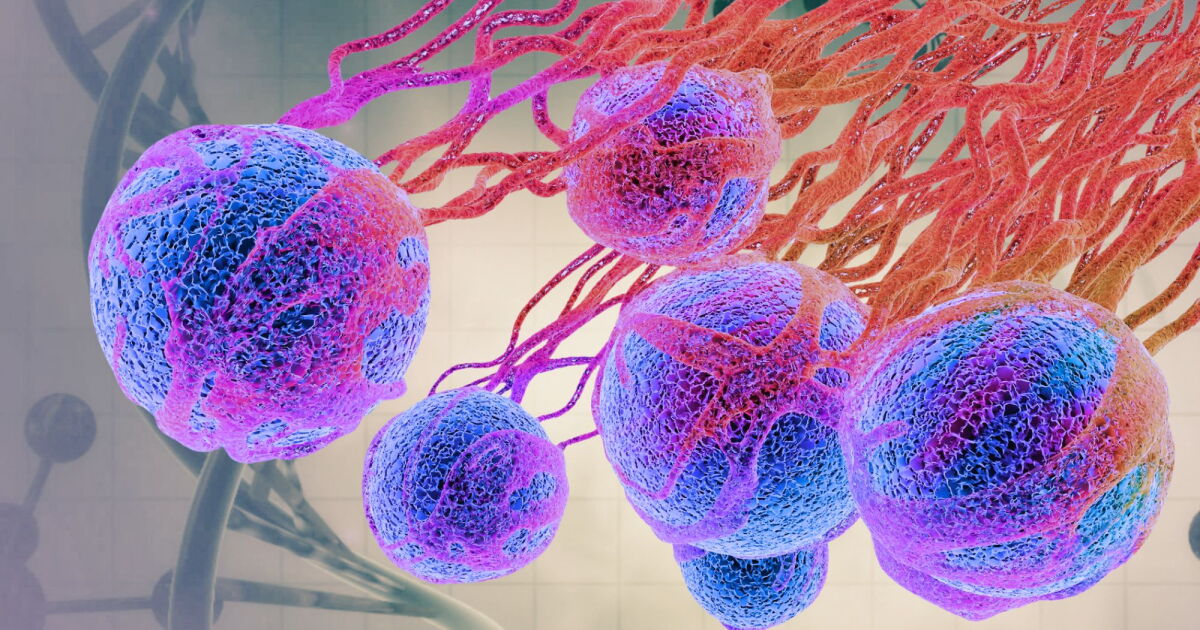 Landmark melanoma vaccine cuts deaths in landmark trial