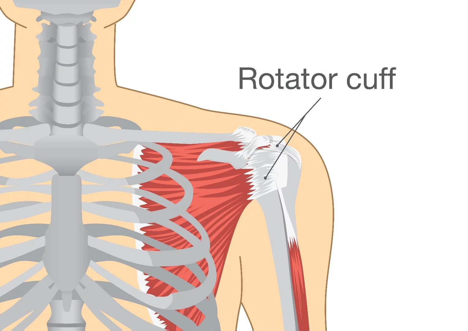 Torn rotator cuffs are a common injury, and are challenging to treat surgically