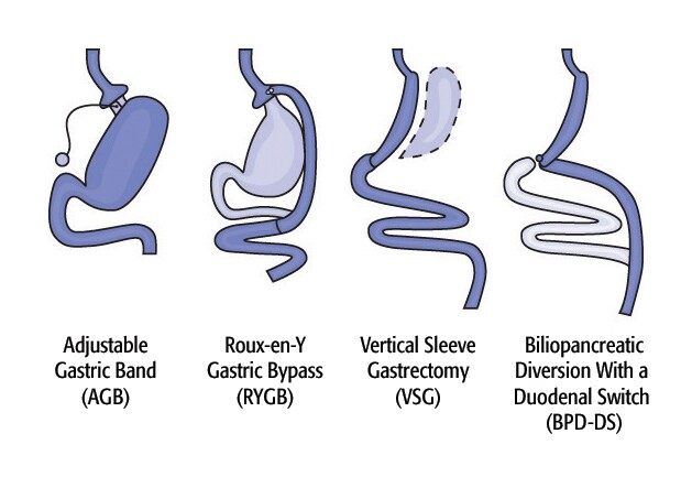 Various approaches toward surgical weight-loss (Photo: National Institutes of Health)