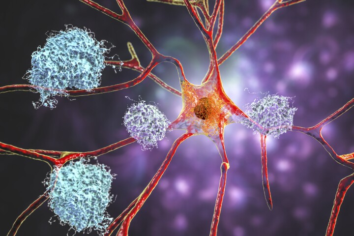 A study has found that light therapy during sleep could help the brain's lymphatic system clear away the beta-amyloid proteins associated with Alzheimer's disease