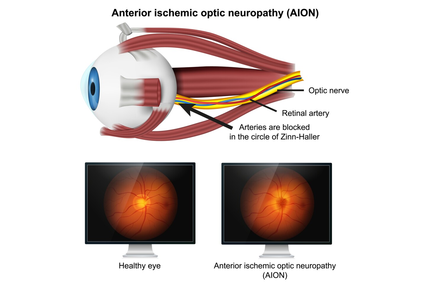 Anatomy of the eye and how anterior ischemic optic neuropathy (AION) presents clinically compared to healthy vision