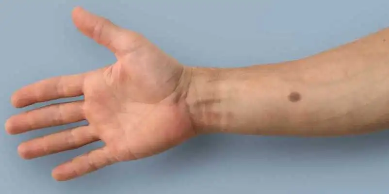 Researchers at ETH Zurich have developed an early warning system for cancer that grows an artificial mole on your skin when it detects certain biomarkers