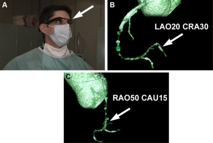 These are CTA images displayed in Google Glass. (A) Cardiologist viewing the CTA images in the upper right visual field on Google Glass (Google Inc, Mountain View, CA) (arrow) during a CTO recanalization attempt. (B, C) Three-dimensional reconstructions projected directly onto the Google Glass screen reveal the exact trajectory of the distal right coronary artery (RCA, arrows). CTA, computed tomography angiography; CTO, chronic total occlusion; RCA, right coronary artery