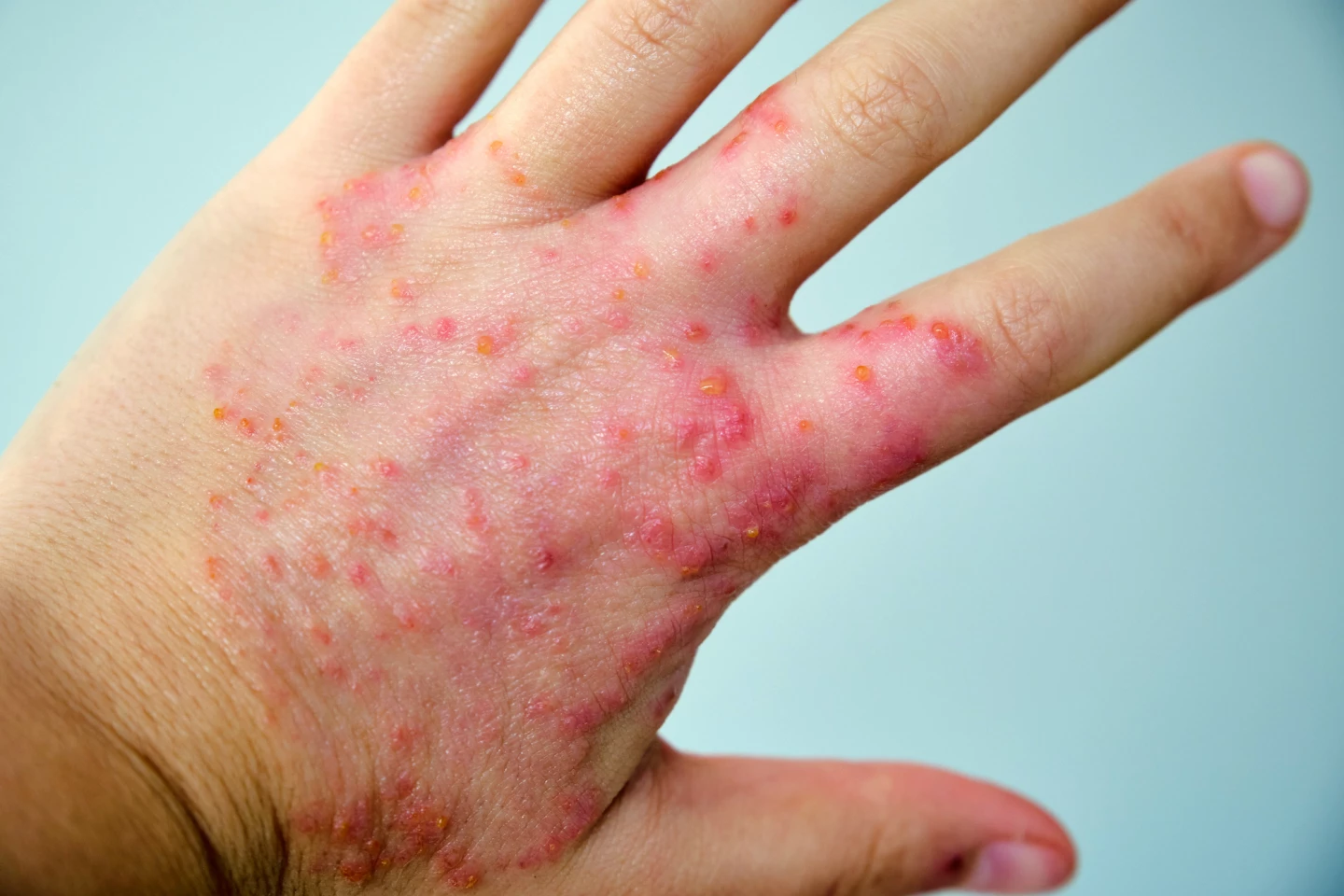 Rezpegaldesleukin delivered fast itch relief and clear skin for many patients in the trial