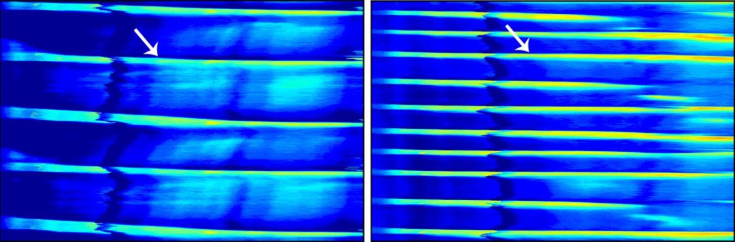 GI contractions in mice with a serotonin deficiency in their neurons; untreated (left) and treated with slow-release 5-HTP (right)