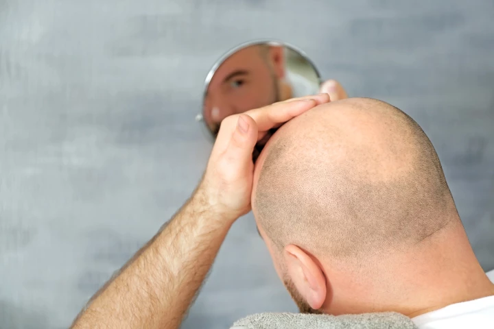 Scientists discover the critical role MCL-1 has in protecting our hair-producing follicle stem cells