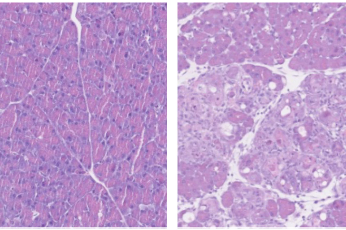 Normal pancreatic cells (left) undergo reprogramming (right) when boosted by B12