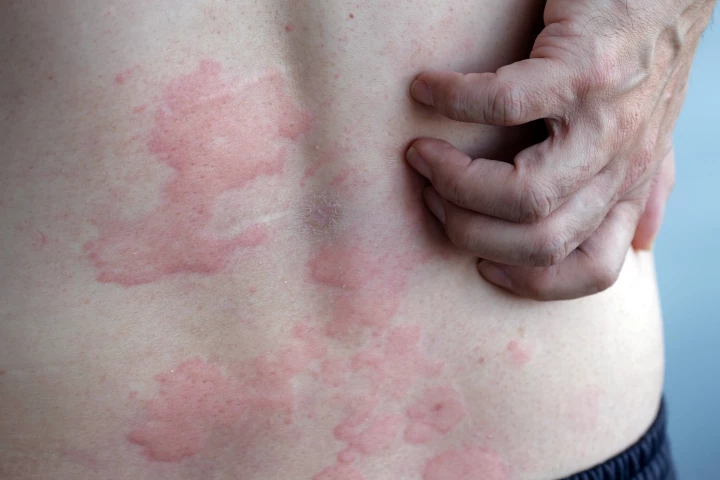Researchers compared chronic hives treatments to find out which are most effective
