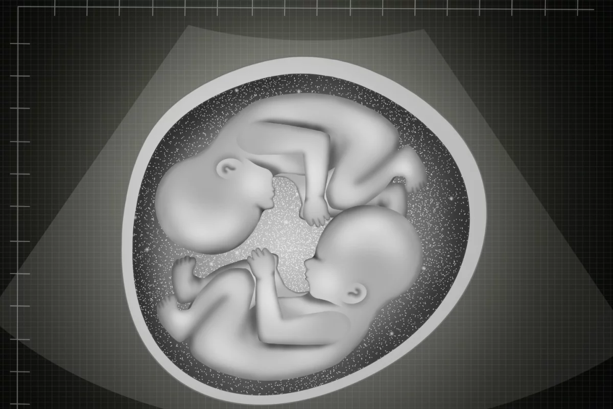 Semi-identical twins born in Australia mark only the second known case in the world