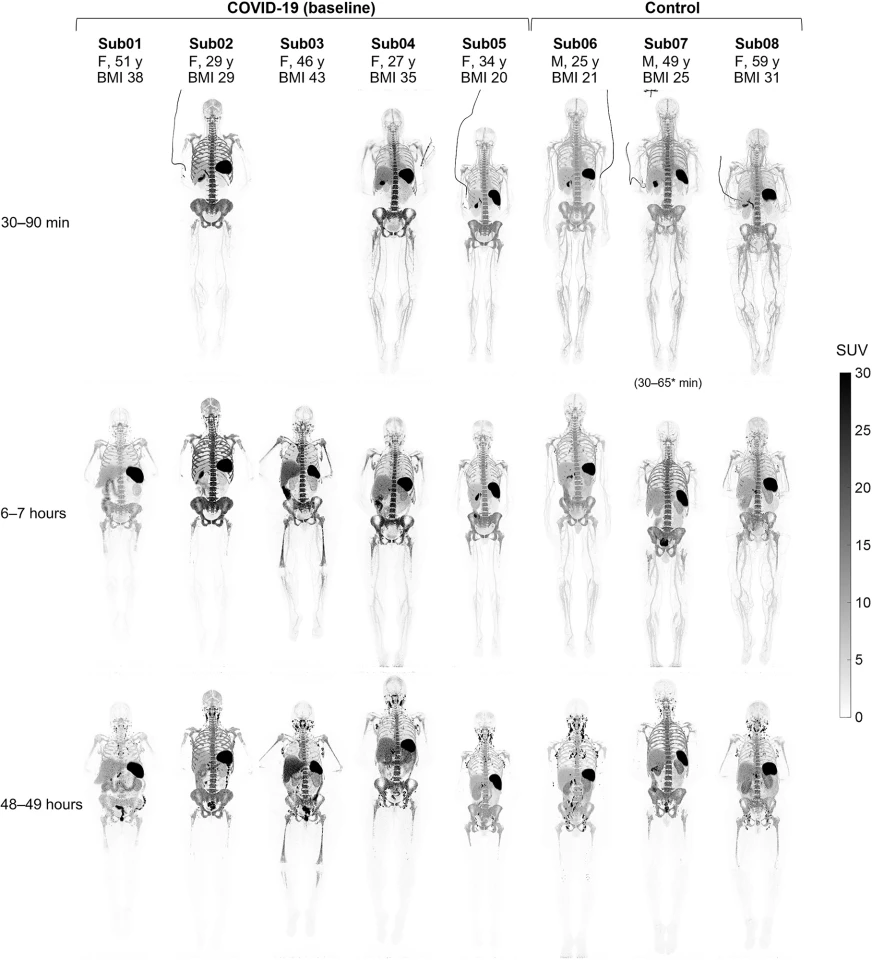 Baseline total-body PET scans of patients recovering from COVID infection and healthy control subjects, taken at three imaging time points