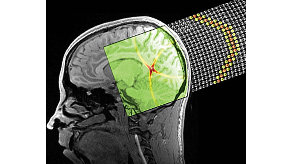 A stylized image depicting a sound bullet superposed onto a brain MRI (Image: Spadoni & Daraio/Caltech)