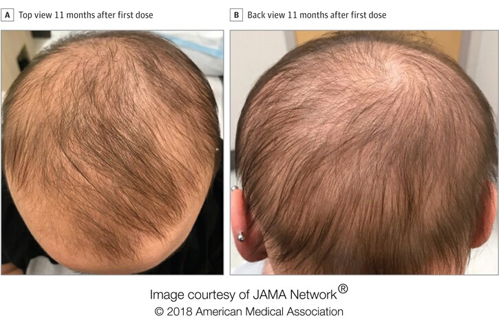 Top and back views, following 11 months of treatment