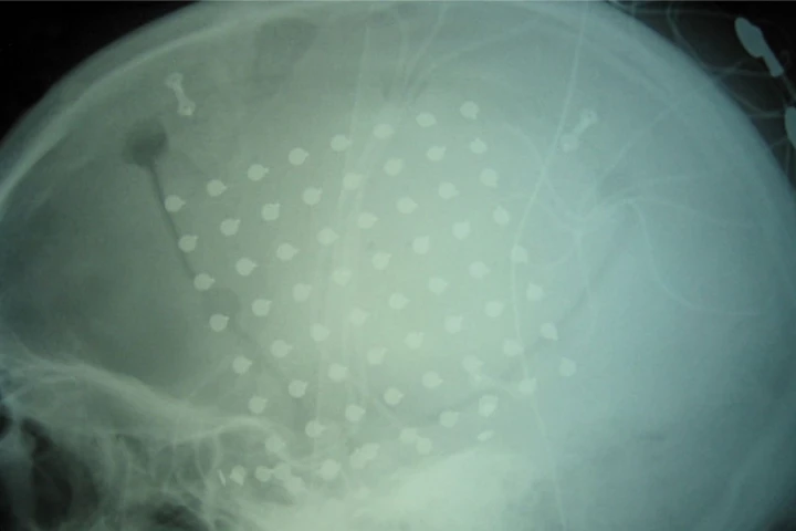X-ray showing the BCI implanted on the surface of a patient's brain
