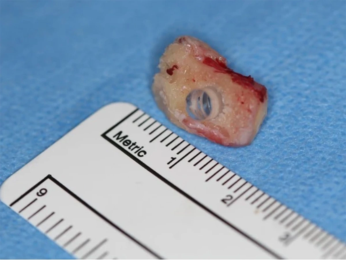 A canine tooth (aka eyetooth) fitted with a plastic optical lens before being embedded in a patient's cheek to grow a layer of tissue
