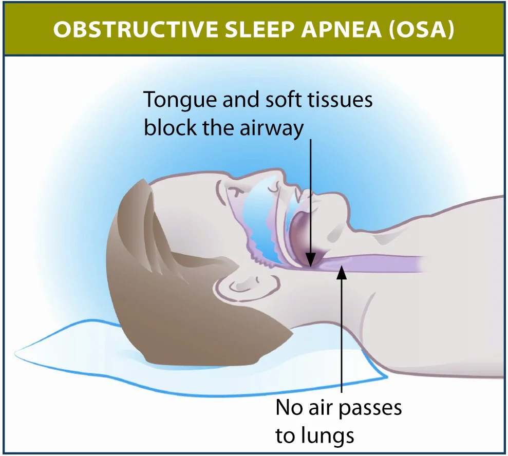 Obstructive sleep apnea can be caused by the tongue and throat muscles becoming too relaxed and blocking the airway