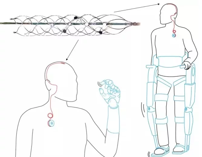 The new device transmits the signals received from a person's brain to a processor capable of controlling a prosthesis or exoskeleton