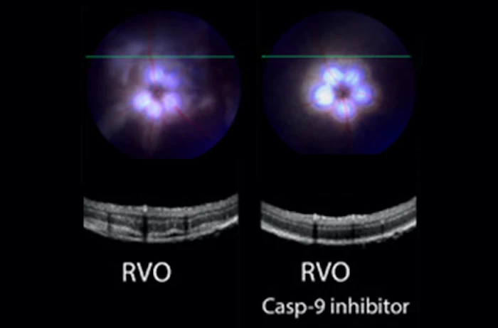 On the left, retinal vein occlusion can be seen to cause swelling in the retina with the retinal layers are less distinct. In the right image, eye drops have restored the distinct layers of the retina