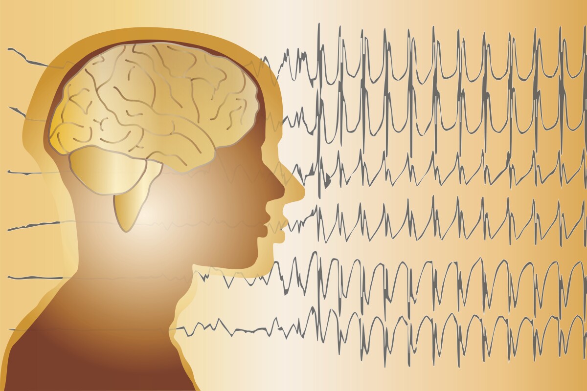 Unexpected epileptic seizures are not only unsettling, but they can also result in injuries
