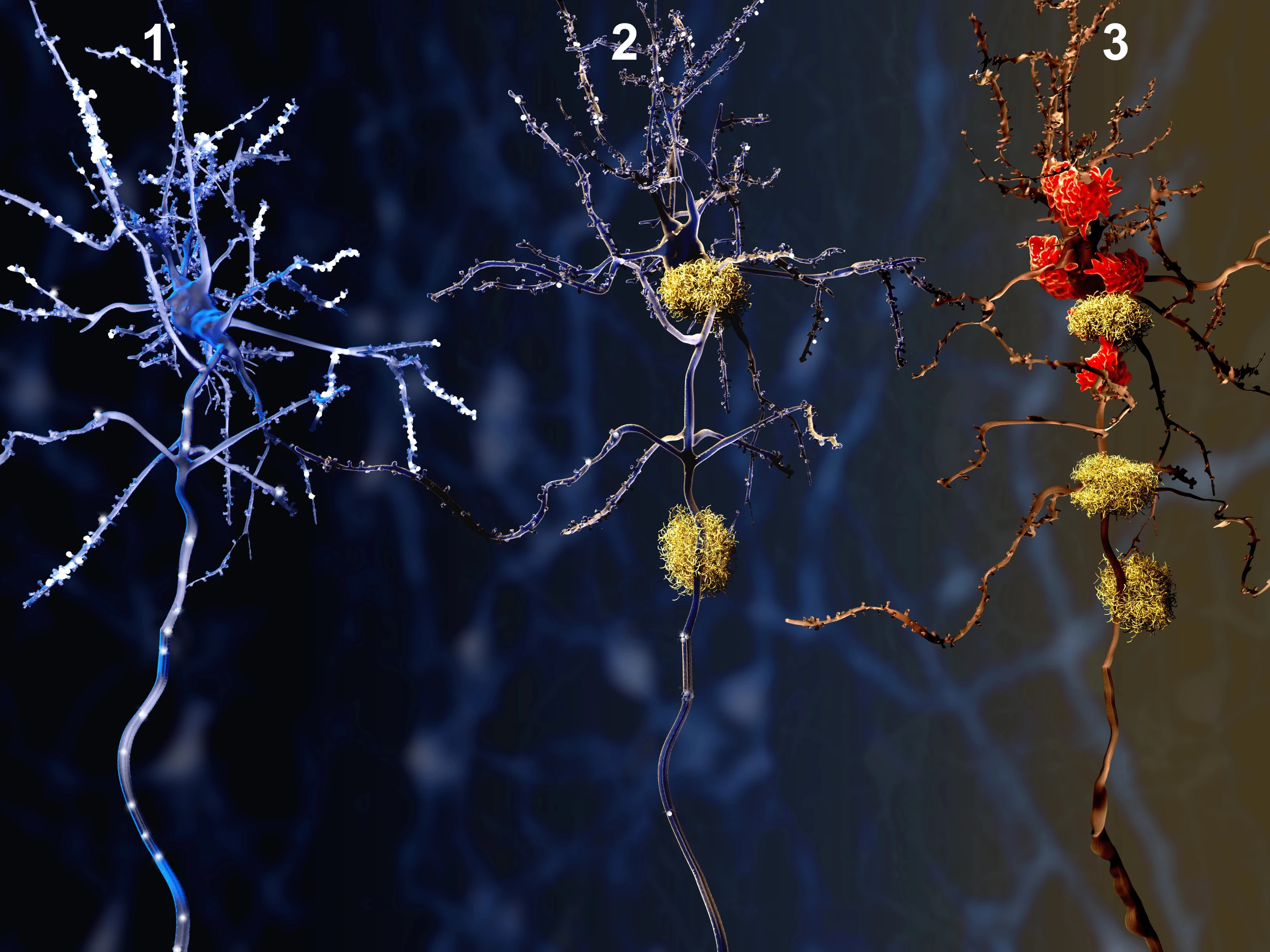 This illustration shows a healthy neuron on the left, a neuron around which amyloid plaques are clumping in the middle, and the resultant dead neuron being digested by specialized cells known as microglia on the right