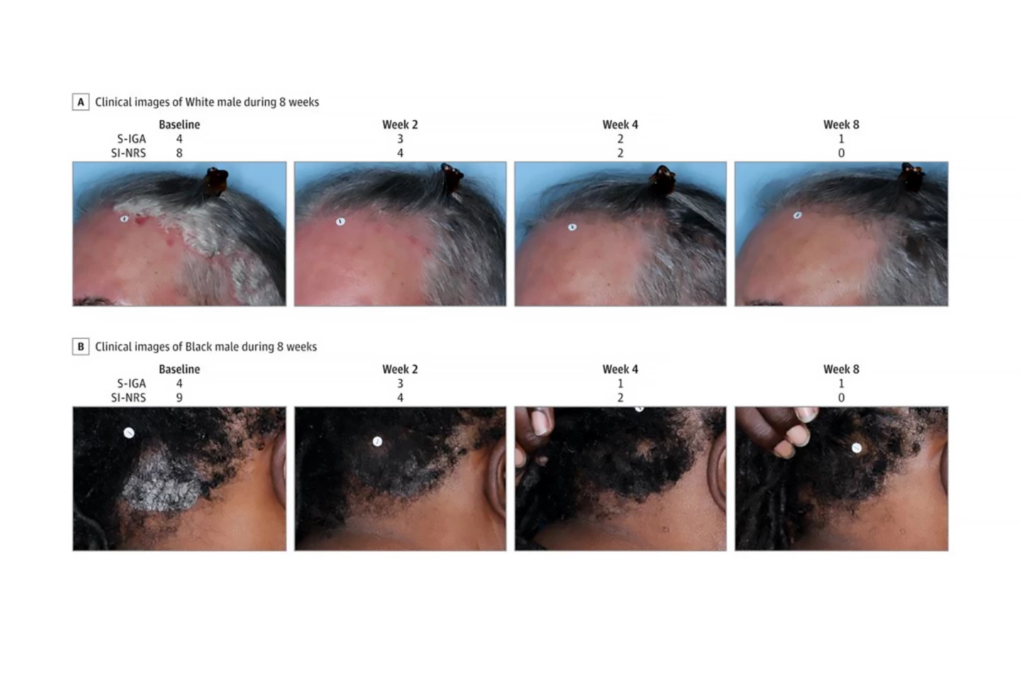 Improvement in scalp psoriasis seen in two trial participants treated with roflumilast over eight weeks