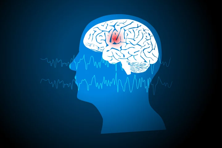 Adults with drug-resistant focal onset seizures are the target of experimental epilepsy drug RAP-219
