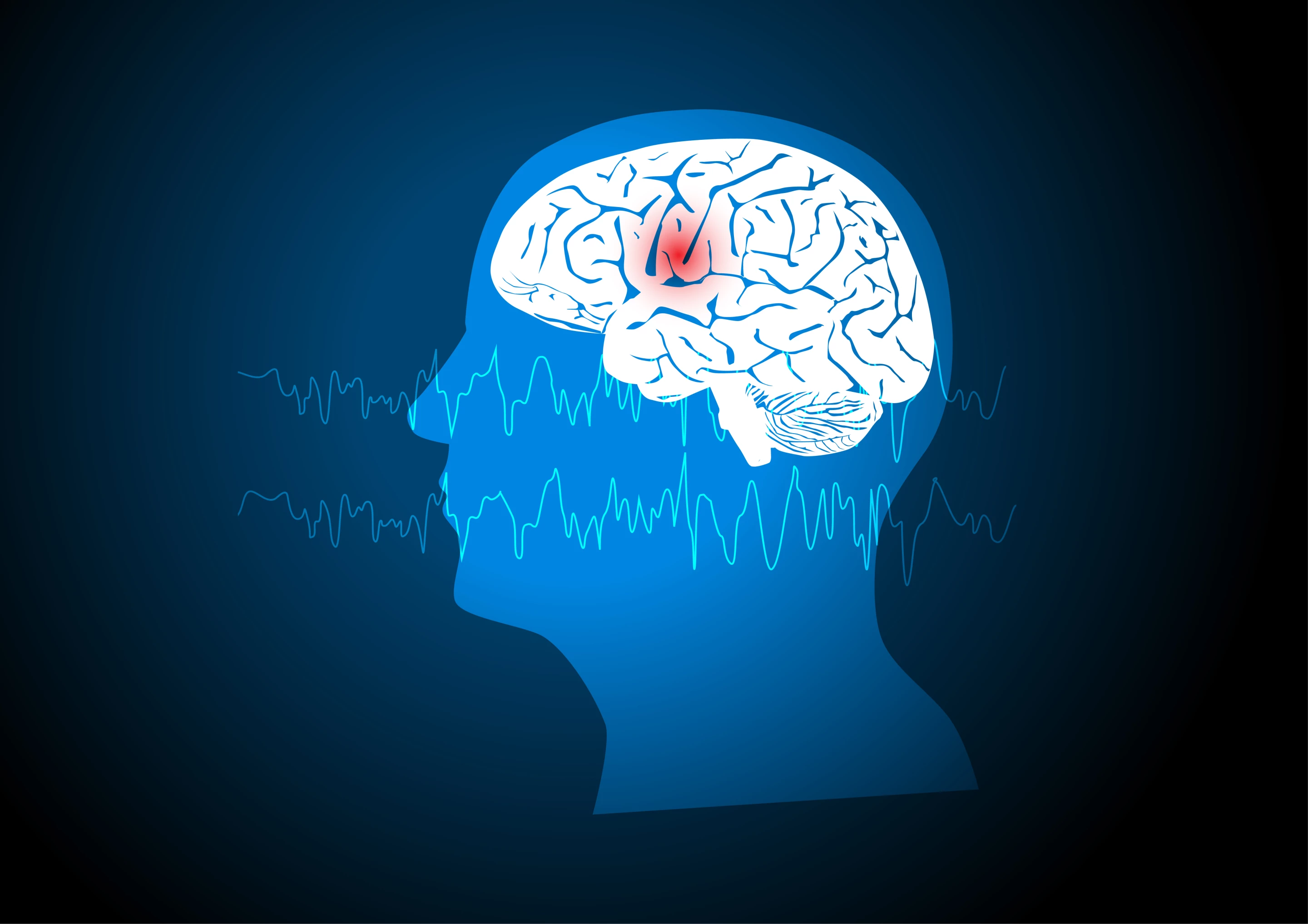 Adults with drug-resistant focal onset seizures are the target of experimental epilepsy drug RAP-219