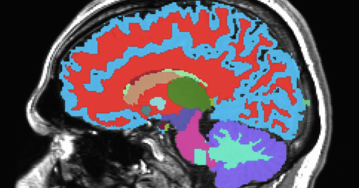 Midlife brain scan predicts future chronic diseases Midlife brain scan predicts future chronic diseases