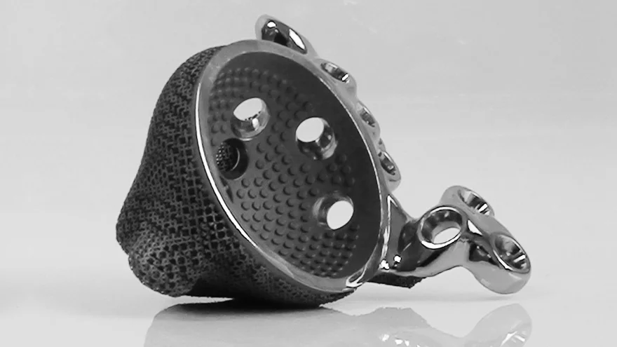 The 3D-printed implant that has given a once wheelchair-consigned teenager the ability to walk on her own