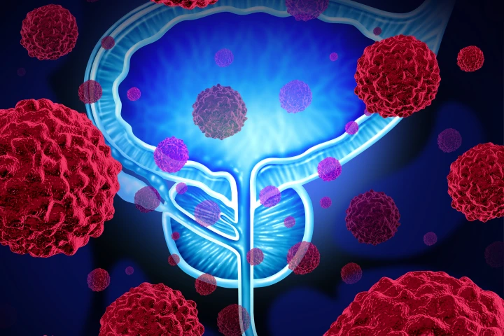 The Odoreader screening method was found to be 90 percent accurate at detecting prostate cancer, which is significantly better than existing testing techniques