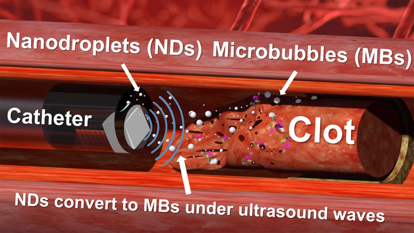 A diagram demonstrating how the ultrasound drill and nanodroplets technique works to destroy blood clots