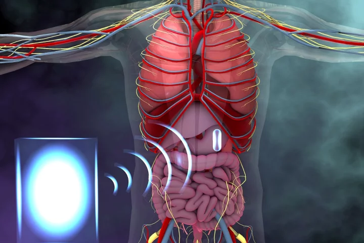 An illustration showing how an electronic device in the stomach could be powered wirelessly