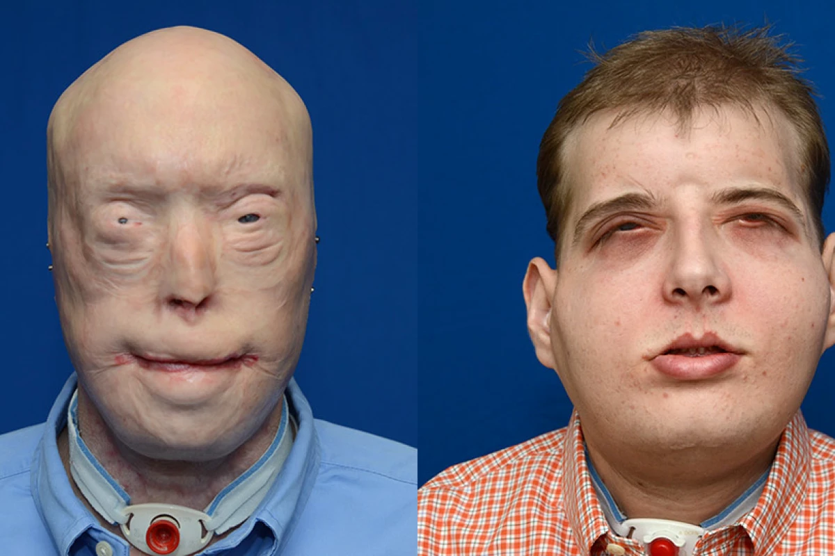 Surgeons at New York University's (NYU) Langone Medical Center have replaced the entire face of a patient in the what is claimed to be the most extensive face transplant ever carried out