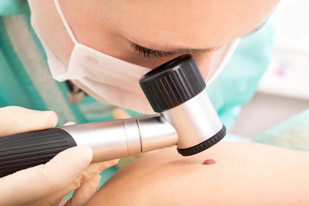 A new blood test could help detect the presence of early-stage melanoma, a common form of skin cancer