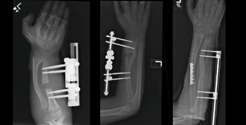 X-ray images of various distraction osteogenesis rigs in place