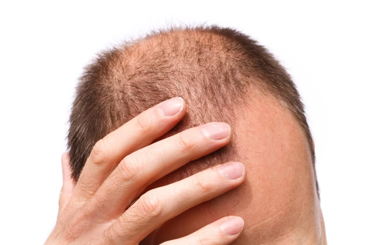 People may conceivably one day use the technology to treat baldness in their own homes