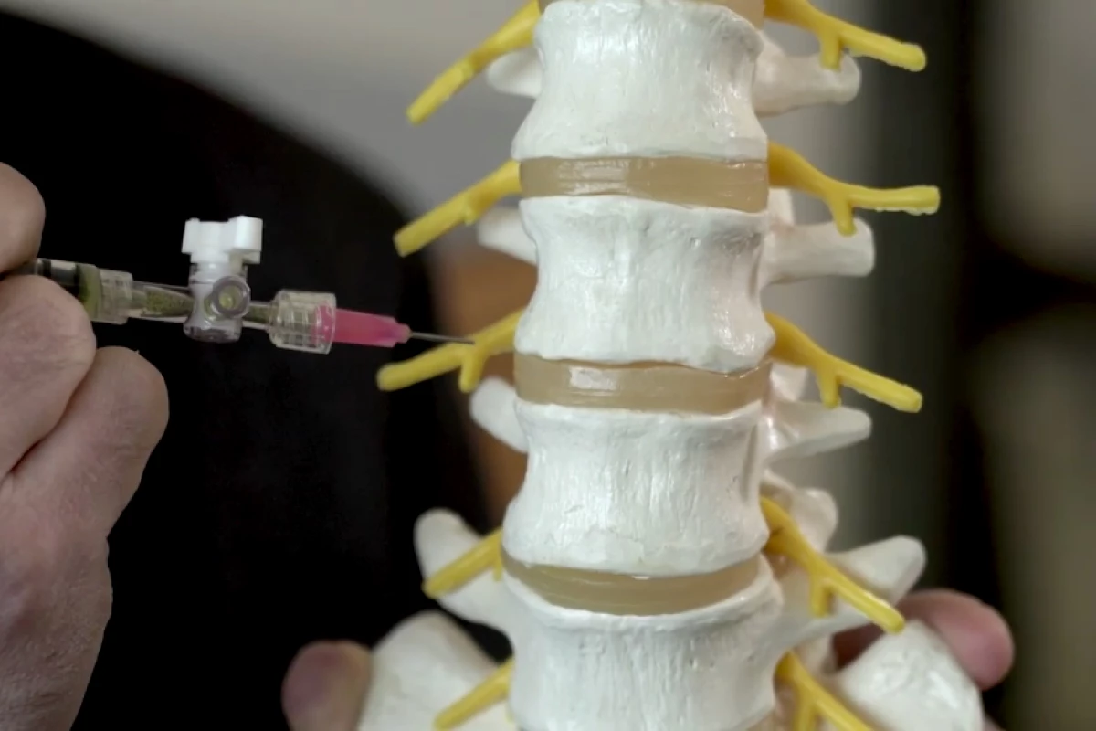 The procedure takes only five to 10 minutes, after an initial discectomy