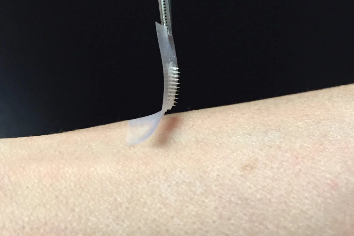 A smart patch boasting an array of over 100 insulin-carrying microneedles could be an option for diabetics in the future