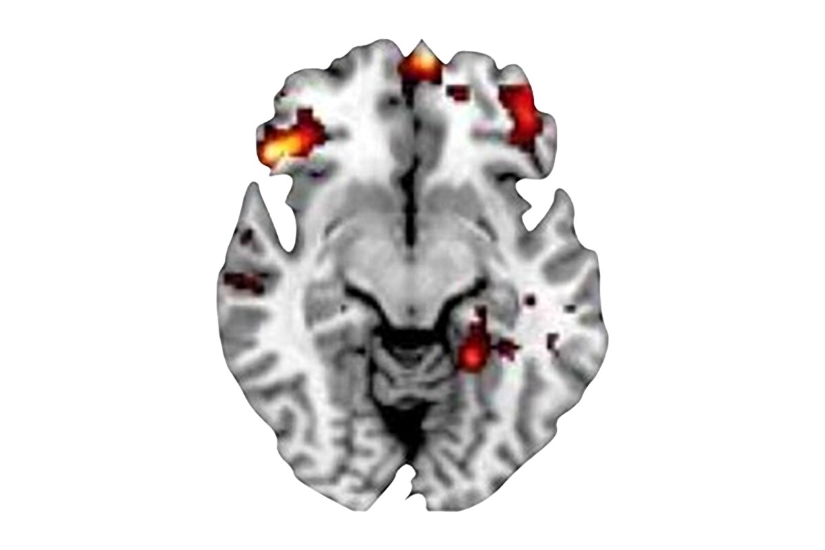 Researchers used MRI scans to examine what happens in the brains of adolescents with OCD during decision-making