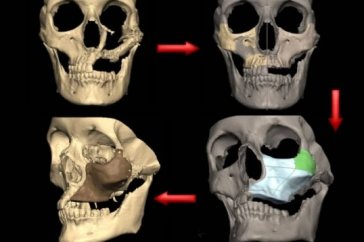 S. Bell: the process of rebuilding a damaged face using engineering-assisted surgery