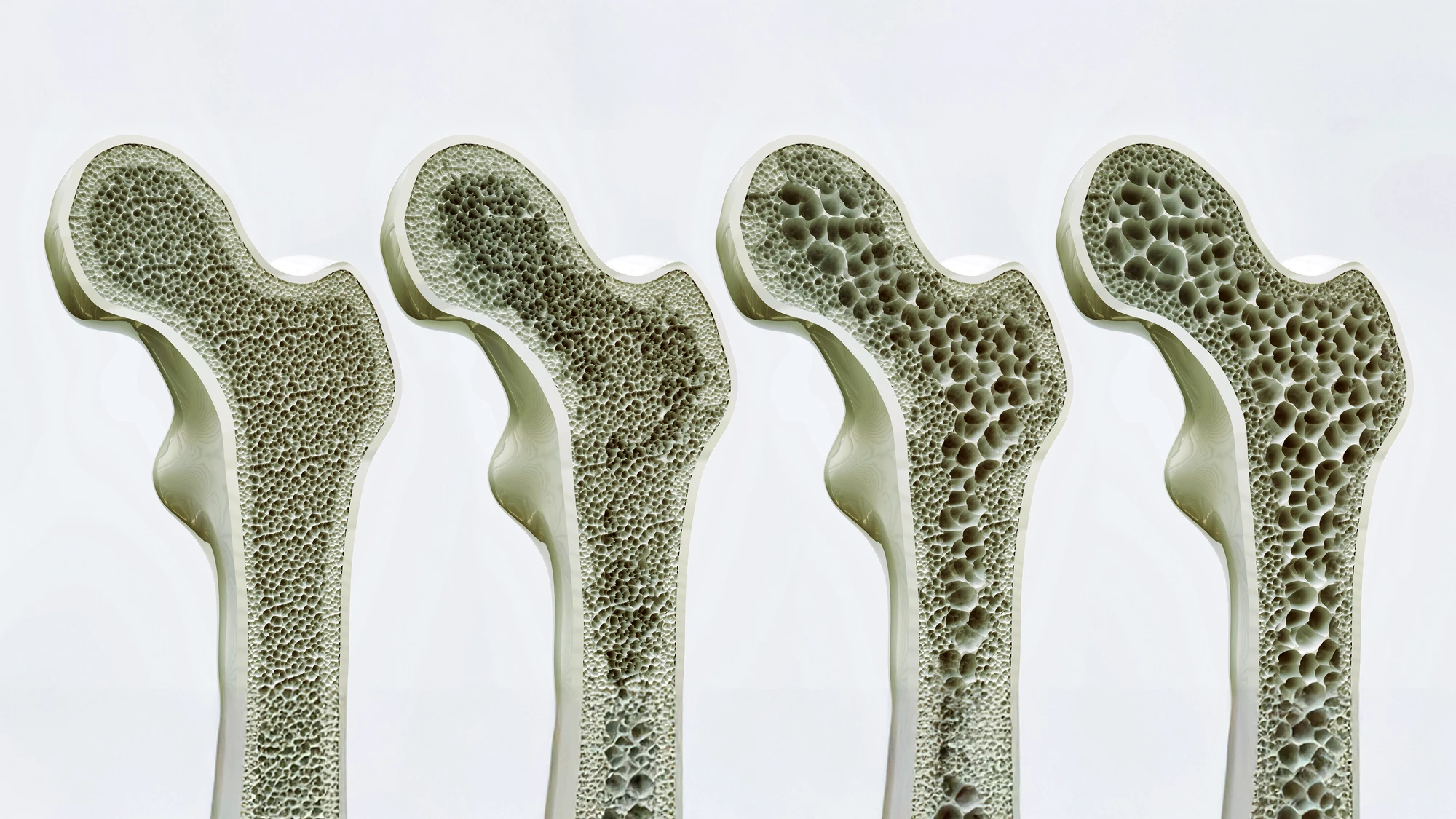 Scientists have discovered a way to significantly improve bone strength