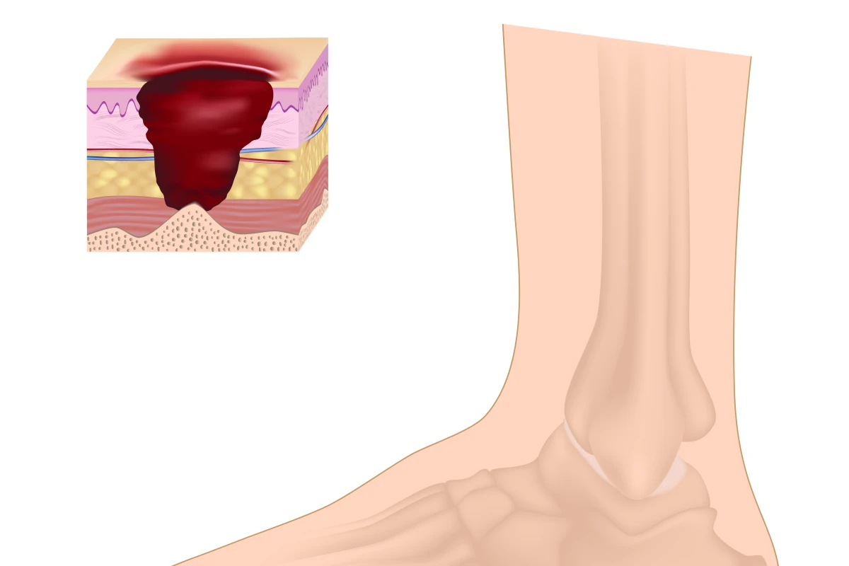 Diabetic foot ulcers may soon be treated with a new drug delivered via a transdermal patch (Image: Shutterstock)