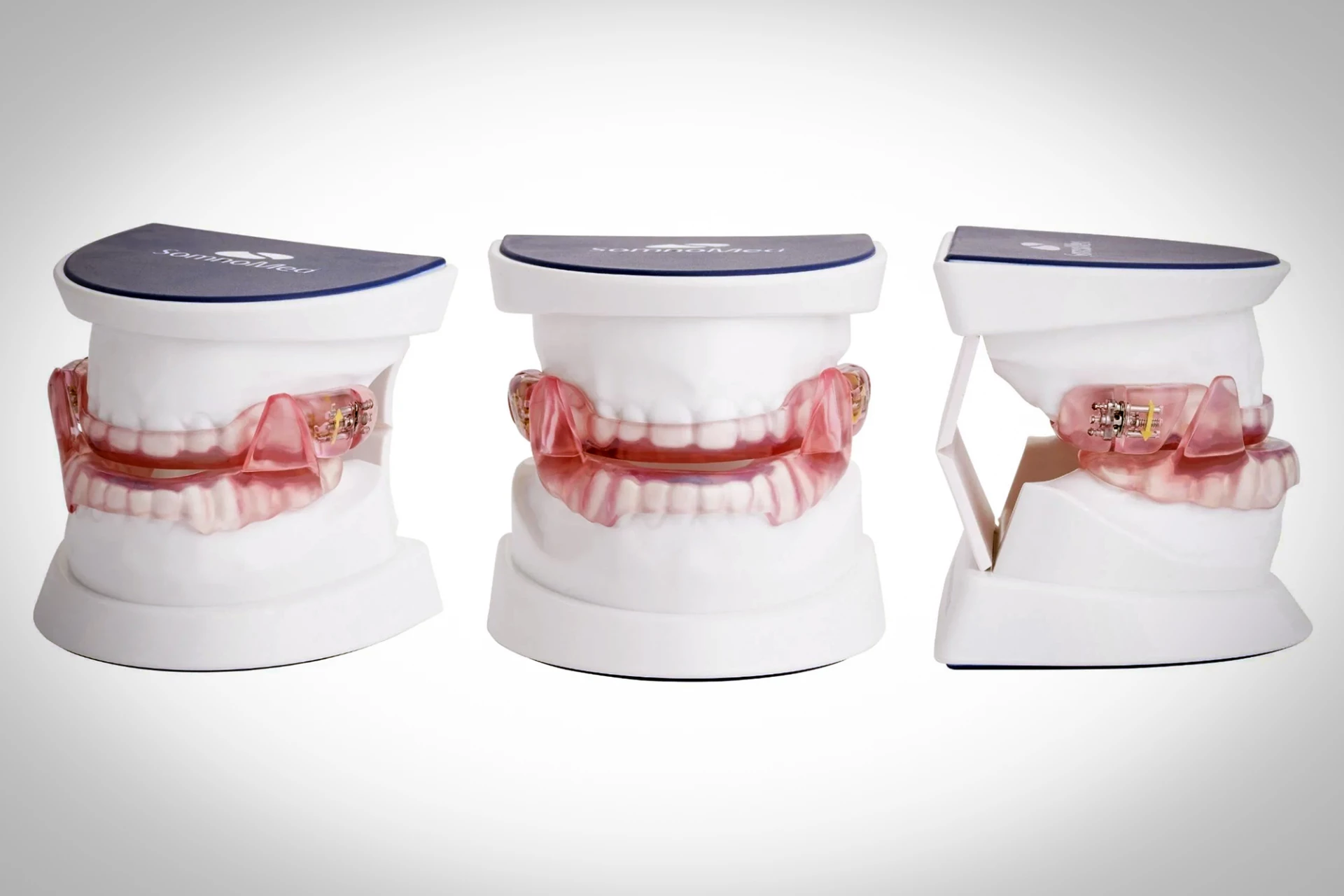 Sleep apnea: Mouthguards less invasive, just as effective as CPAP