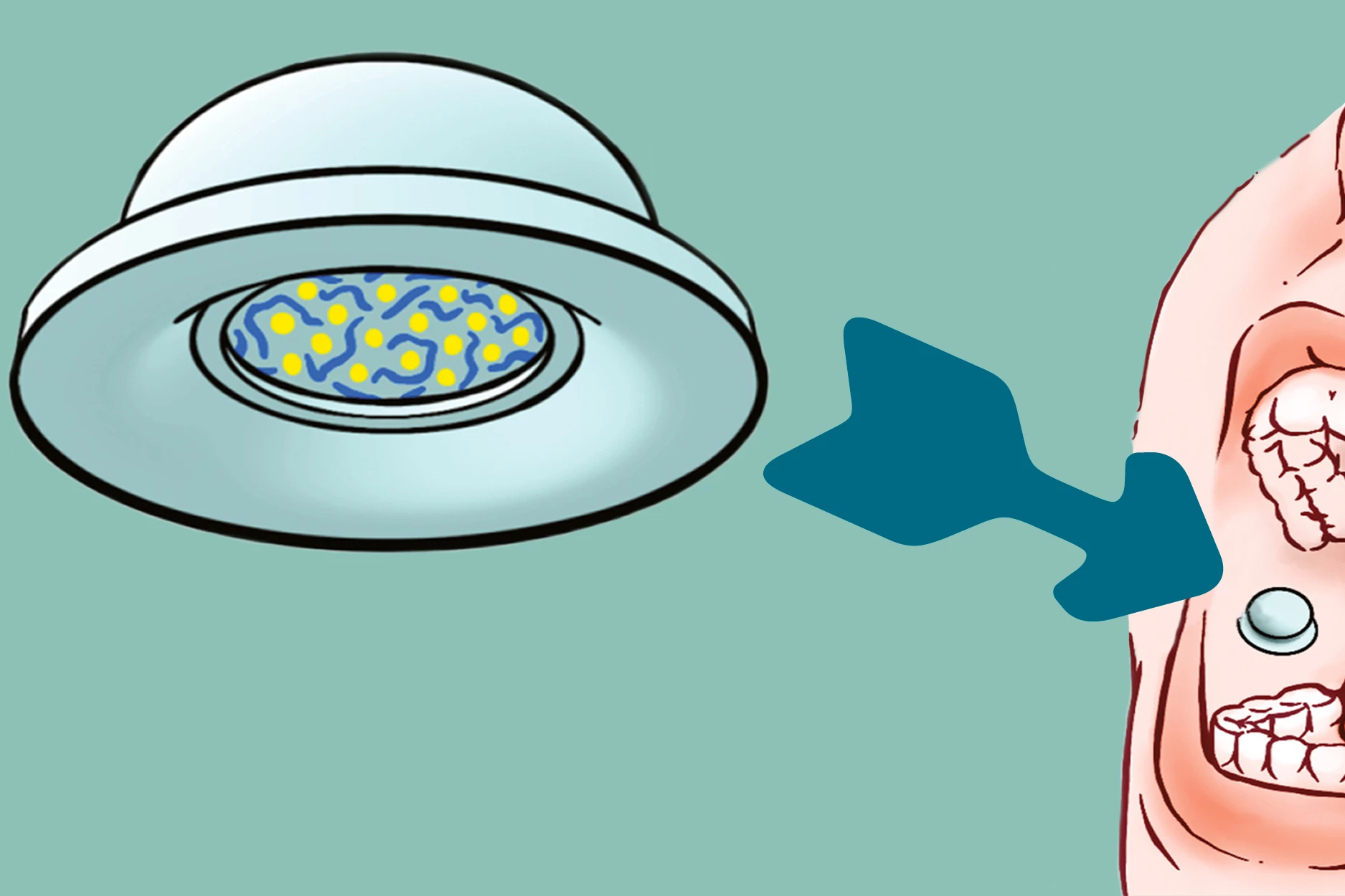 The drug-loaded suction cup gets temporarily adhered to the inner lining of the cheek