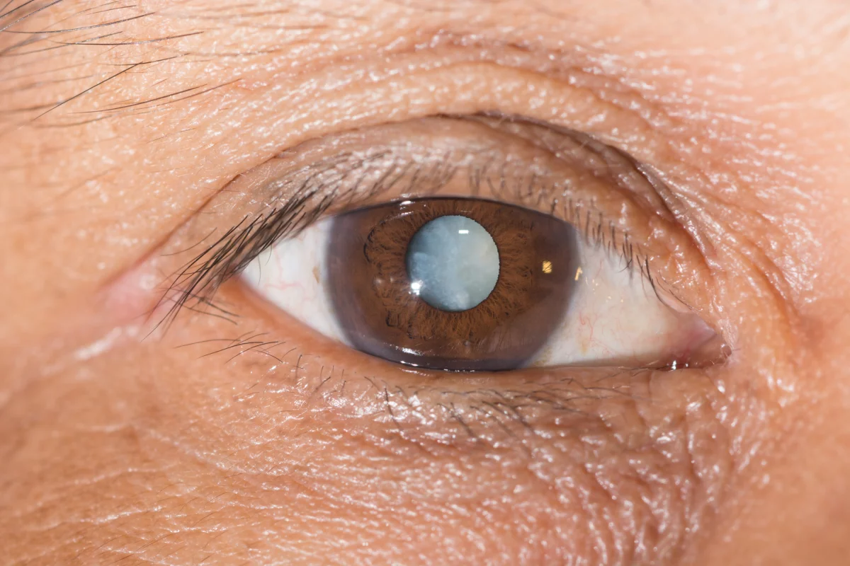 A new drug to help clear cataracts shows promise in tests in mice