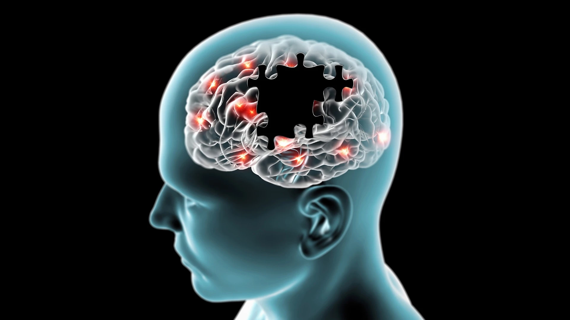 New research has revealed frontotemporal dementia results in a person losing the ability to daydream or let their mind wander